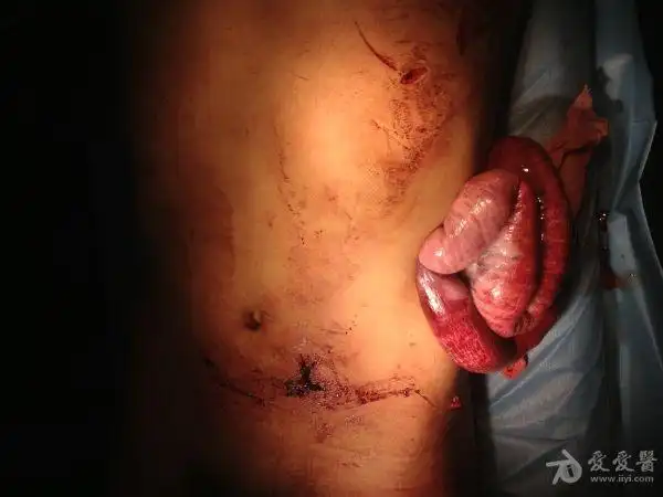 腹部刀刺伤至小肠外露图片