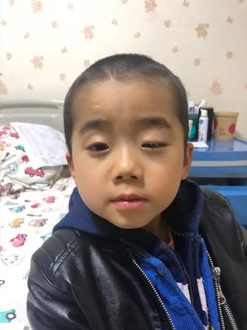 汤医生你好我们昨天在本地医院湘雅做了斜视手术他们诊断为