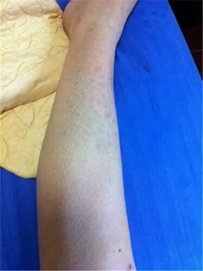 鱼鳞病初期图片 (68)