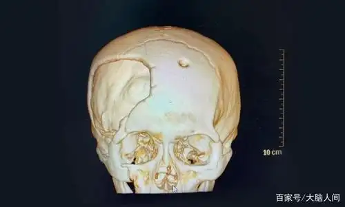蓝十字脑科 90后小伙头颅受损大面积凹陷 颅骨修补术后他重现笑颜