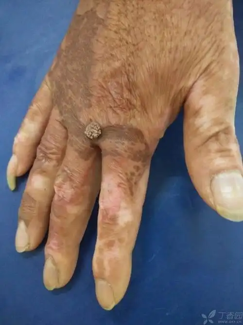 手部菜花状肿物一例 [病例帖]