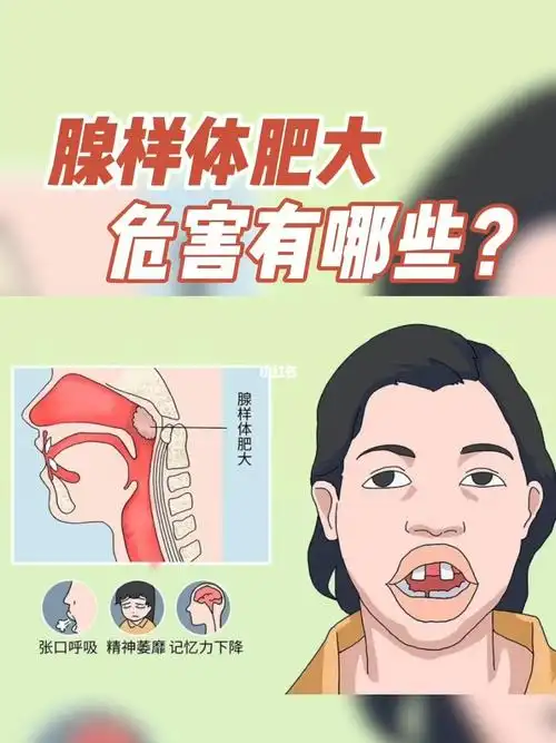 腺样体肥大的危害