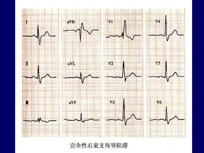 异常心电图图谱汇总ppt