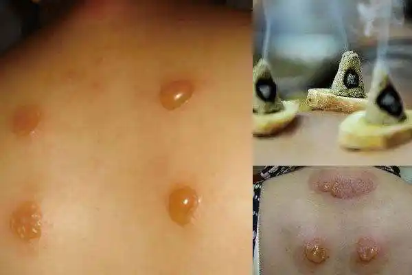 艾灸中出现的千奇百怪的现象, 你了解多少