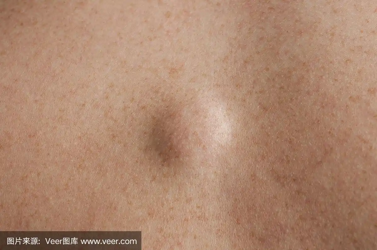 脂肪瘤近距离拍摄一个白人男子的背部