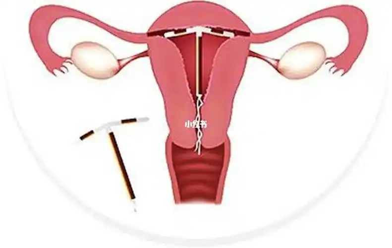 曼月乐环  可以在 #子宫  内局部释放 #孕激素  , #孕激素 可以抑制