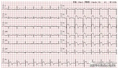 每日读图 || 第1268期 急性广泛前壁心肌梗死