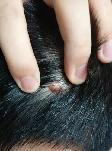 后脑勺有一个半个花生米大的棕色的小肉球,很小的时候就有了,不痛不痒