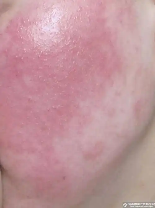 皮肤过敏,又红又痒,怎么办?