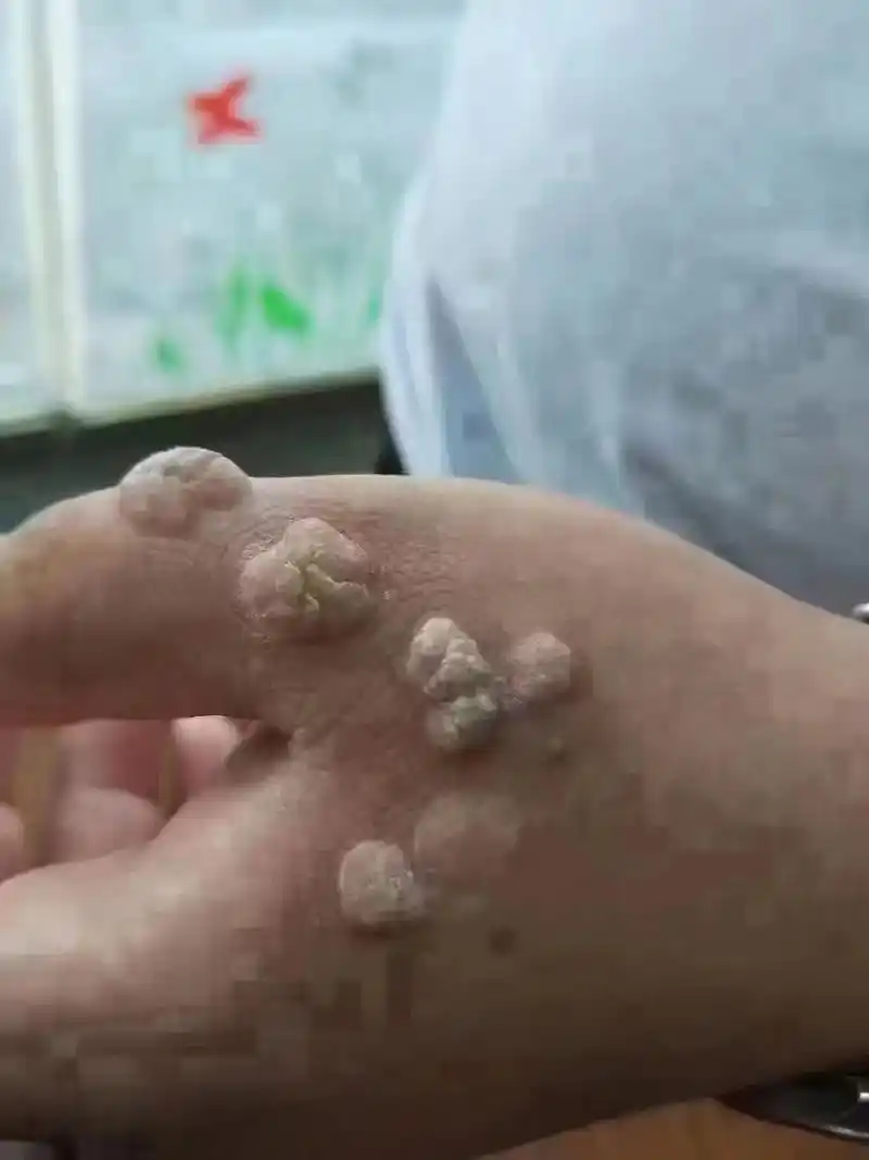 93 疣类知识: 扁平疣性状:传染性! 初期约1-3年为近肤 - 抖音