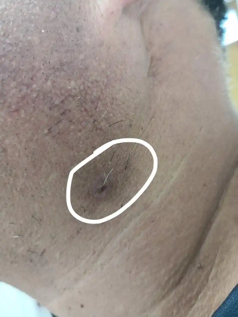 颈部寻常疣激光治疗去除后恢复期症状#皮肤##解决皮肤问题专注皮肤