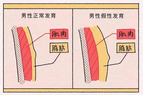 男性也会面临的尴尬之男性乳房发育症