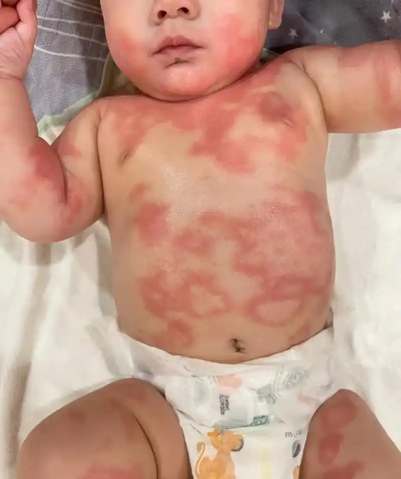 "这就是我家七个月的宝宝,从一个月开始起湿疹,症状是干,起皮 - 抖音