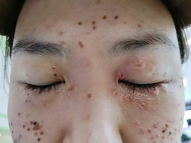 图片可能引起不适……眼周汗管瘤掉痂了,今天算第四天_圈子-新氧美容