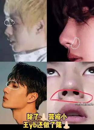 王一博鼻子疤痕又暴露了之前广告就被质疑不知是卡粉还是伤疤