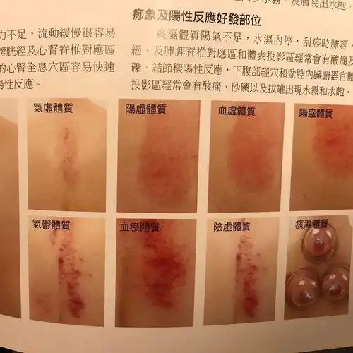 养生 刮痧 排毒 观察自己出的痧来查看自己的体质 求医不如求己!