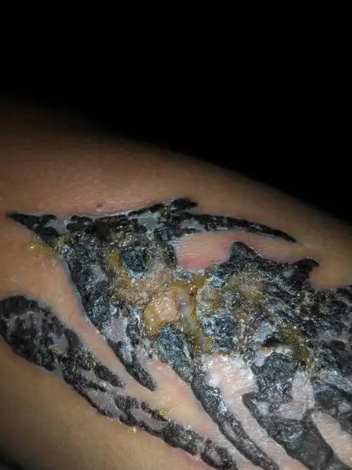 洗完纹身之后变成这样了,怎么办啊有点疼,还流脓.