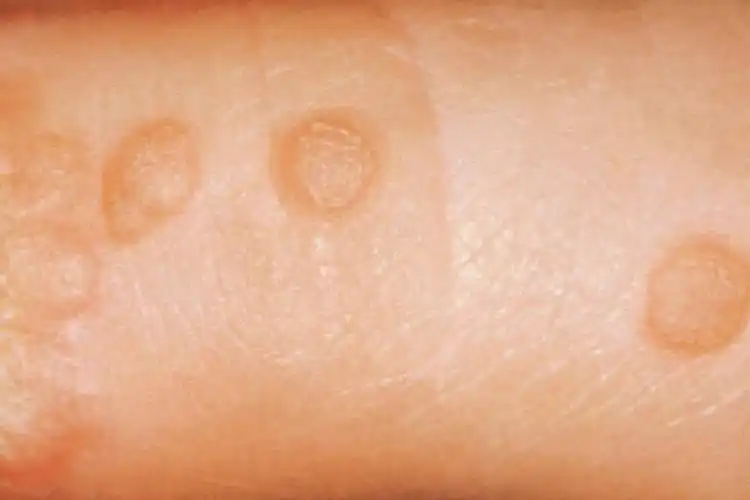 妇产科概述手上的hpv病毒,一般为感染hpv所引起的疣类疾病,常见的为