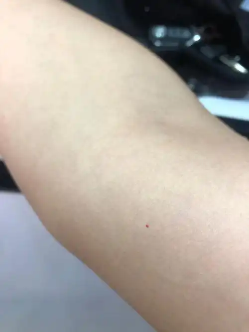 手臂上长了几个小红点,略有凸起,不痛不痒,按压后红色不消失,这是啥