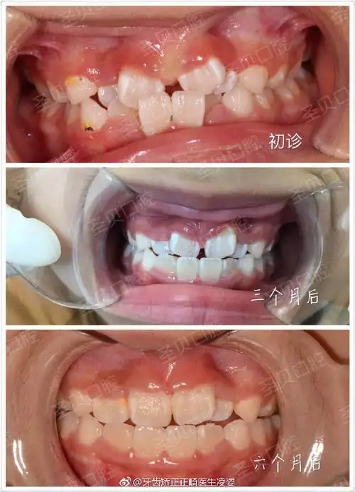 发现孩子牙齿不齐,需及时矫正!为了孩子颜值,宝妈宝爸必看.