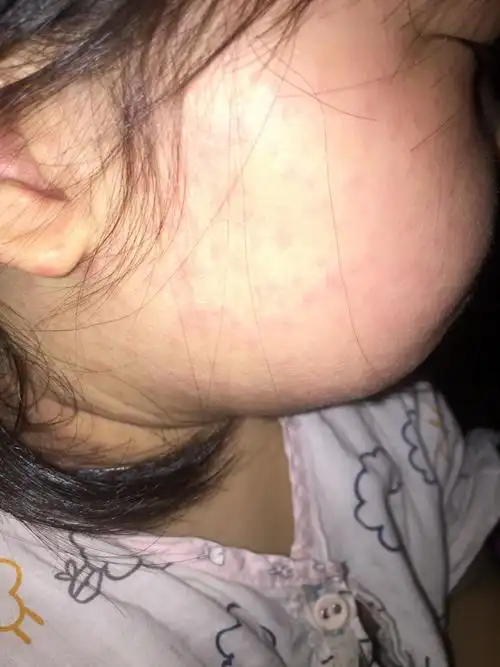 今天开始更加严重了.昨天医生说是病毒疹.我还是不放