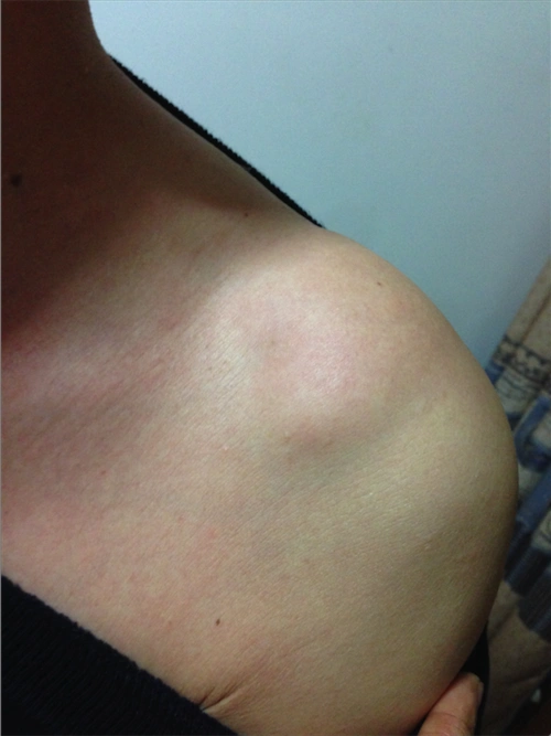 脂肪瘤图片_脂肪瘤症状表现图片大全_有来医生