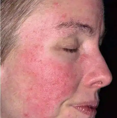 很可能是你踩了这5个敏感肌护理雷区!_肌肤_皮肤_误区