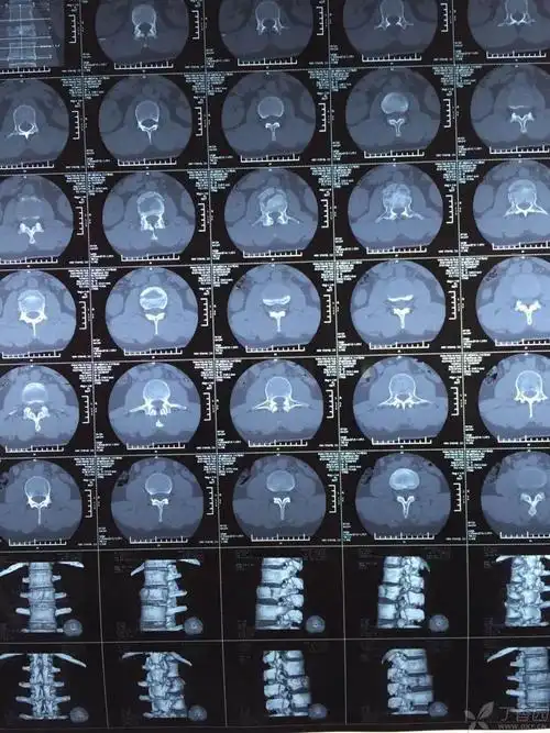 腰椎压缩骨折治疗?求大神!