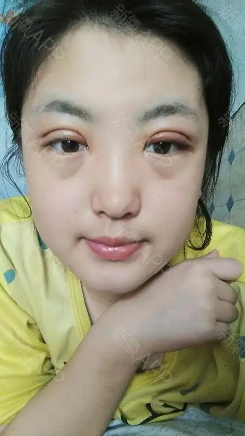 眼部 | 术后当自强 | 北京同城 | 双鸭山同城 | 眼部综合 | 眼部