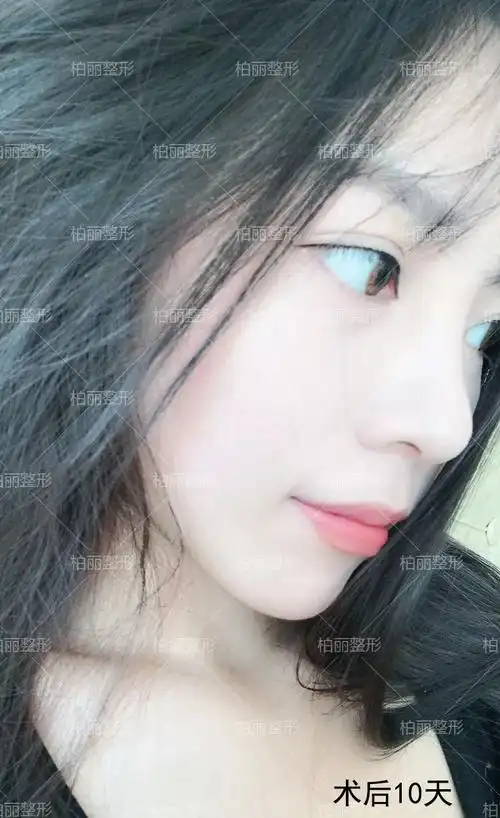 现在隆鼻都流行做的百搭鼻是怎么做的内附真人案例