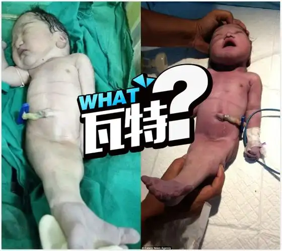 妈妈生下美人鱼宝宝,概率十万分之一