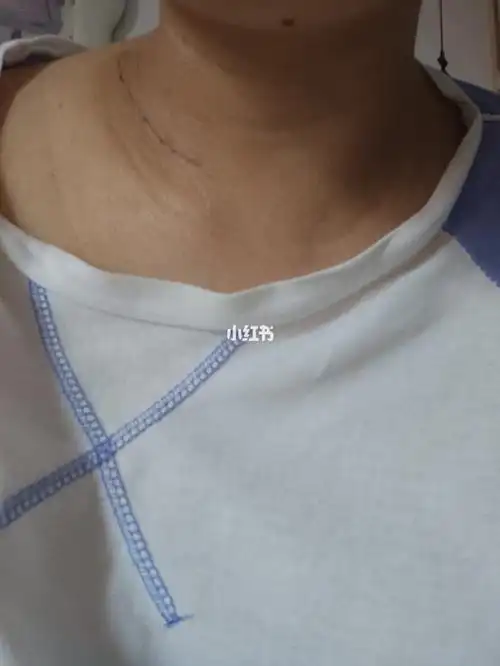 颈部脂肪瘤切除第17天真怕长增生