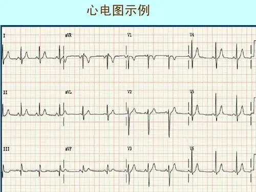 第5页 (共68页,当前第5页) 你可能喜欢 心电图详解 正常心电图波形