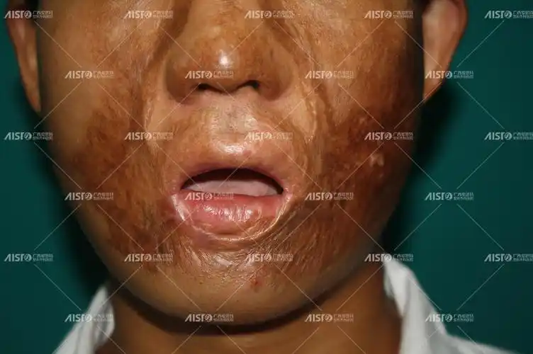 24岁帅小伙全脸烧烫伤毁容满脸疤痕治疗效果分享