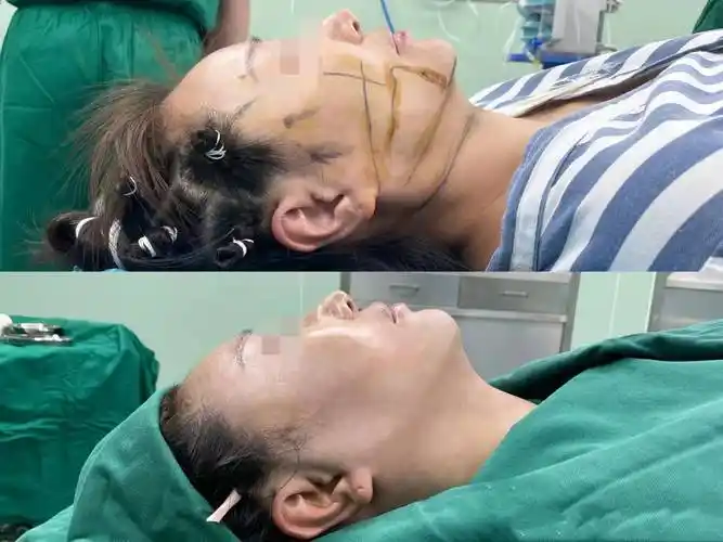 拉皮手术后会老的更快吗?事实的真相如何?