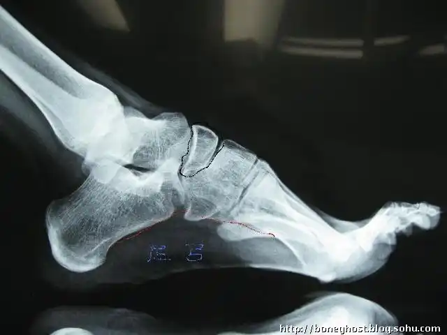 黑线画出的就是足舟骨,姚明骨折的那块骨头.