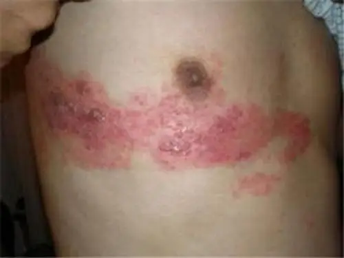 单纯疱疹症状发生的基本情况介绍