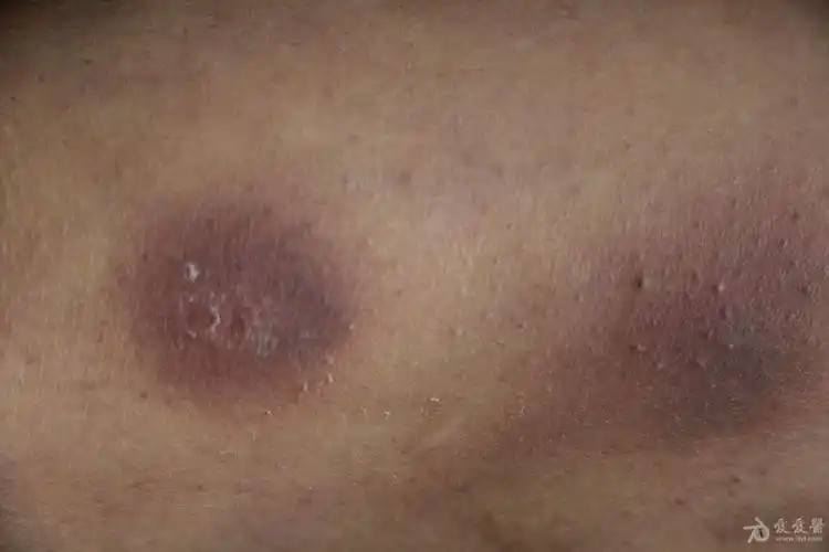 继发性血小板减少紫癜一例