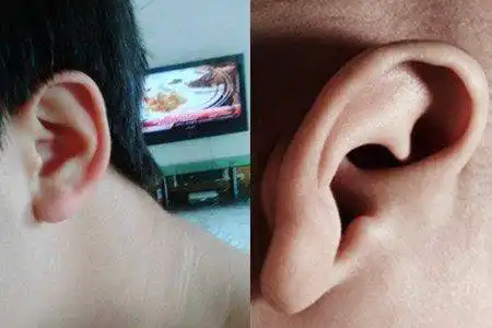 【图】耳垂斜线皱纹 是不是得了冠心病的前兆