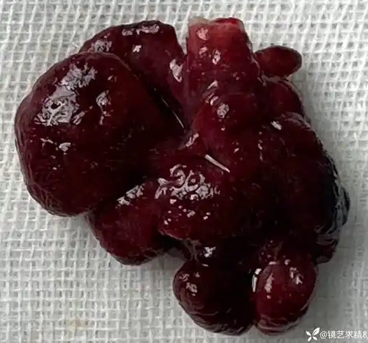 伪装成痔疮脱出的直肠息肉