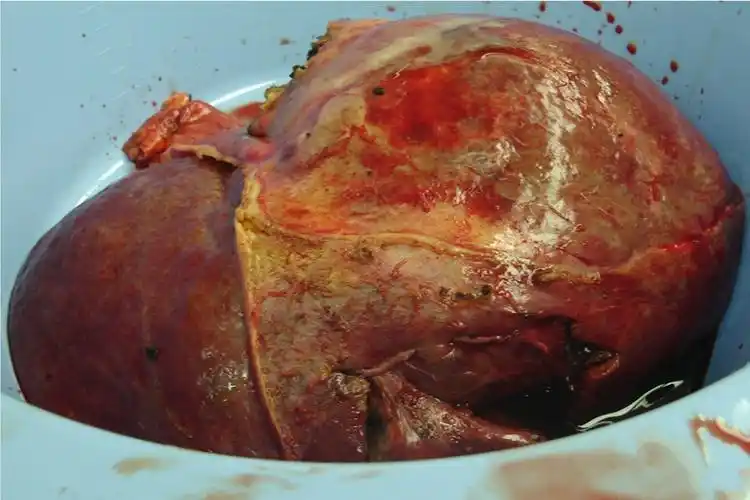 酒精肝的损伤症状的图片