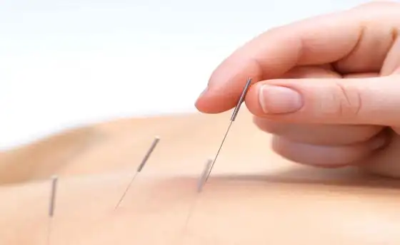 大马中医师及针灸师大多数都使用扎针法治疗病者.