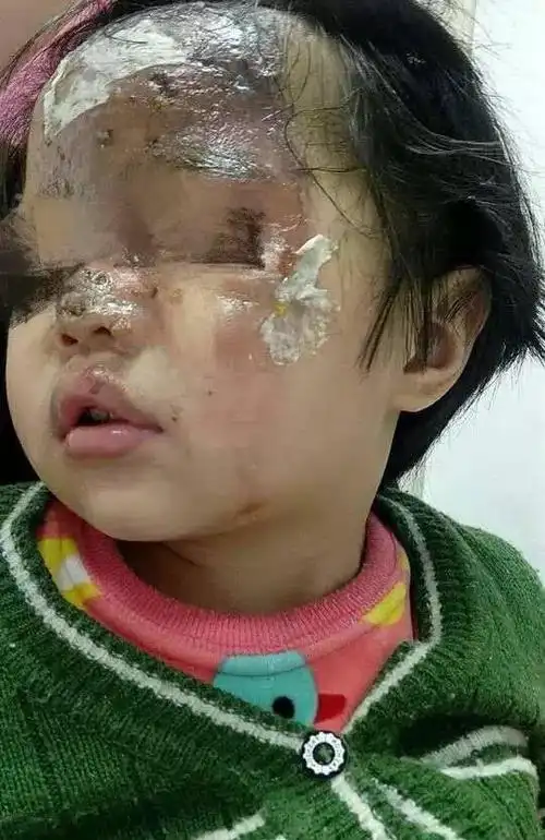 保温杯吸管中喷出热开水温州女娃脸部被严重烫伤