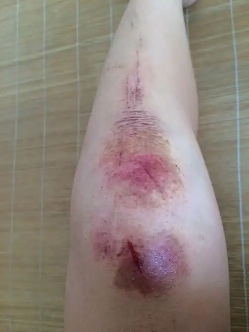 小腿摔伤后如何快速消肿?