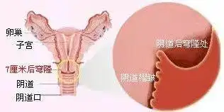 女性常见的子宫位置,是前倾前屈位,便于向后向下的子宫颈开口浸泡穹窿