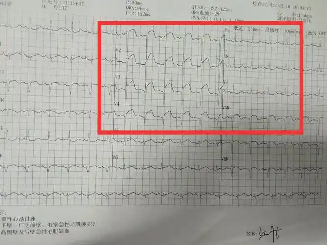 急查心电图结果回示:1.窦性心动过速;2.