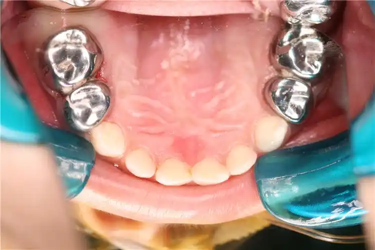 儿童及青少年滞留乳牙及埋伏阻生牙,多生牙,畸形牙等无痛拔除5.