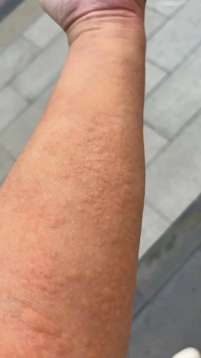 似乎是高原反应后遗症之一,人生第一次寻麻疹,运动后出汗会加剧 - 抖