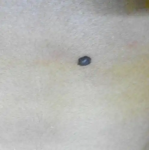 肚子上有这样个黑点 是痣还是什么 ?身上有好几个还 都长毛.