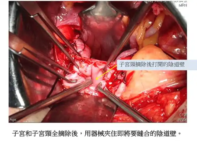 一般传统开腹子宫全摘除术解决方案ppt13页